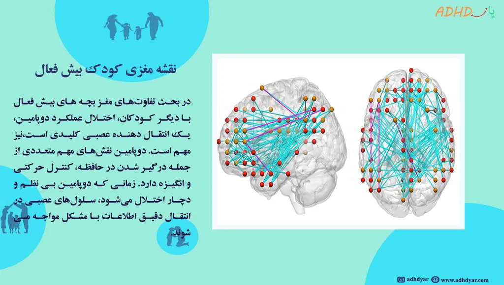 نقشه مغزی کودک بیش فعال