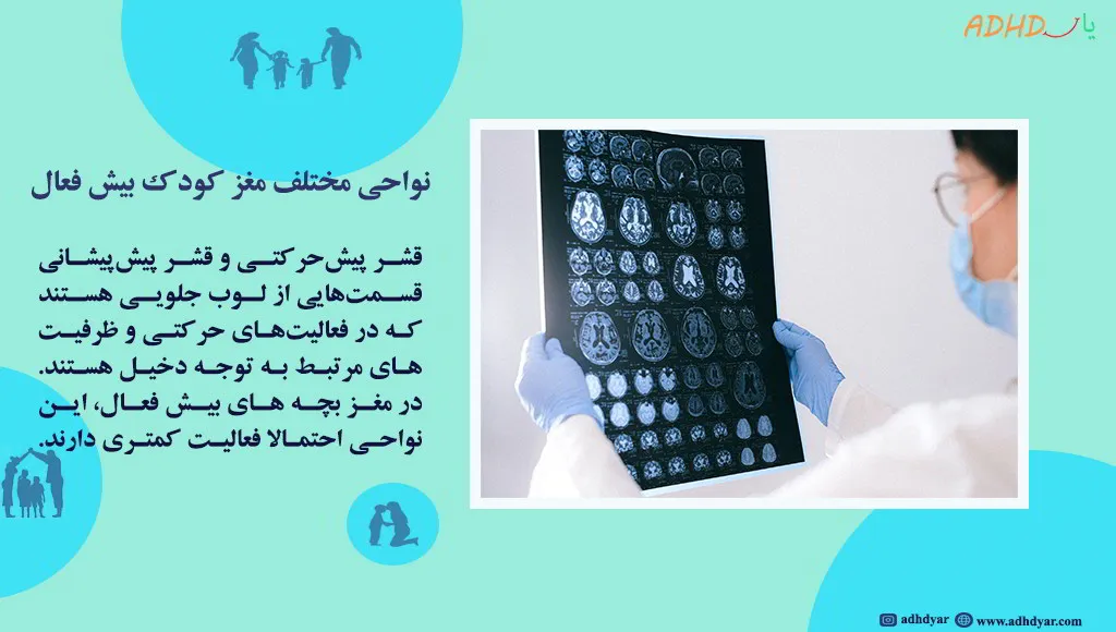 قسمت های مغز بچه های بیش فعال