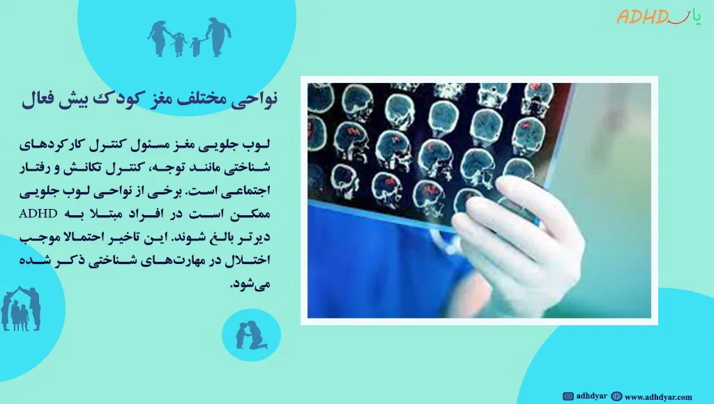 نوار مغز کودکان بیش فعال
