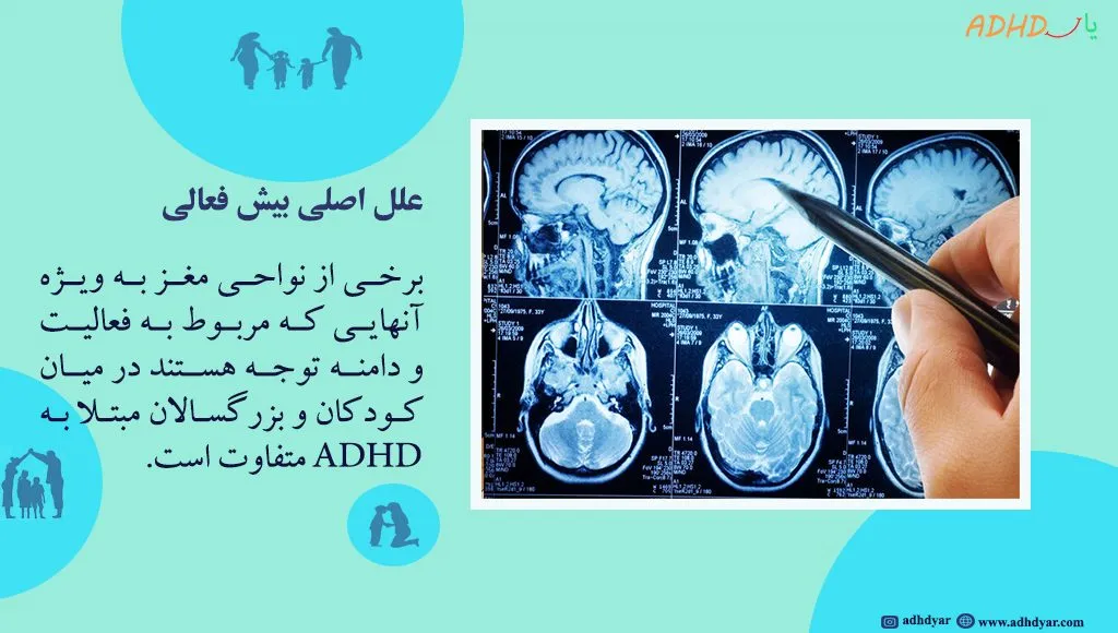 تشخیص بیش فعالی با نوار مغز